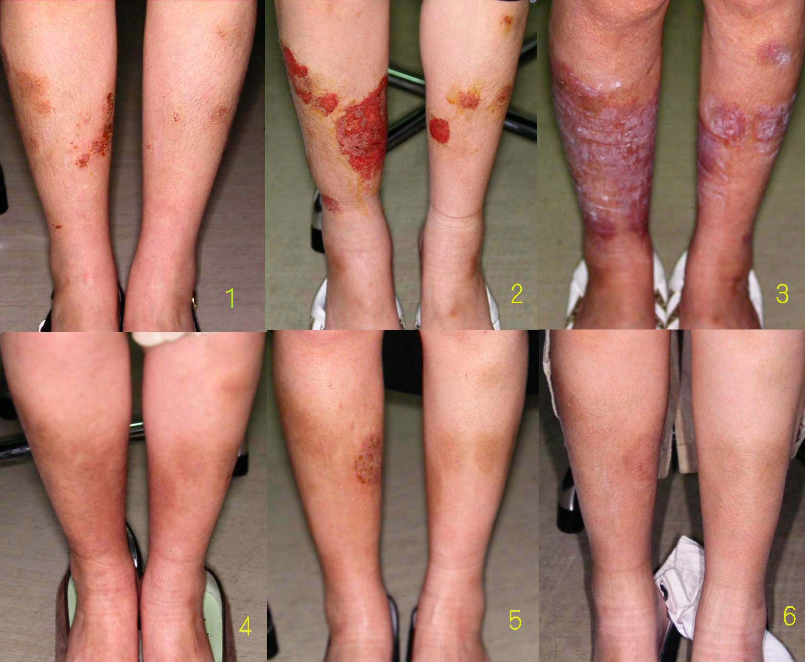 アトピー性皮膚炎とステロイド離脱 深谷元継 Withdrawal From Corticosteroids In Patients With Atopic Dermatitis Mototsugu Fukaya Md